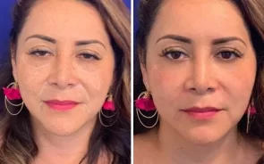 Tratamiento de Lifting Facial Láser Ultherapy 