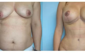 Antes y después de la abdominoplastia