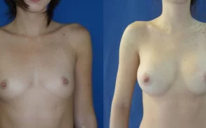 Antes y después de cirugía aumento de senos