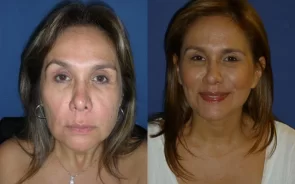 Antes y Después Rejuvenecimiento Facial