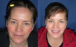 Resultados Rejuvenecimiento Facial sin Cirugía