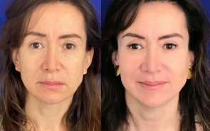 Tratamiento Total Fix con Hifu Facial y AquaGold