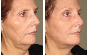 Resultados Lifting Facial Láser Ultherapy